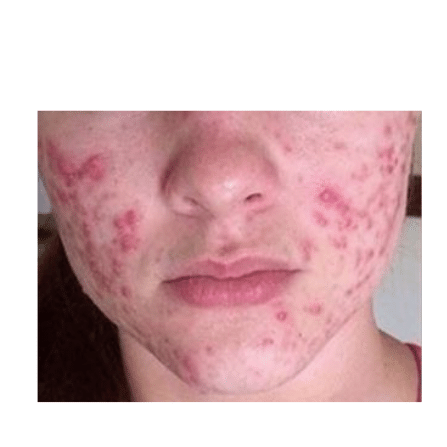 Valérie Garros - Mon magnétisme - Problème de peau- l'acné